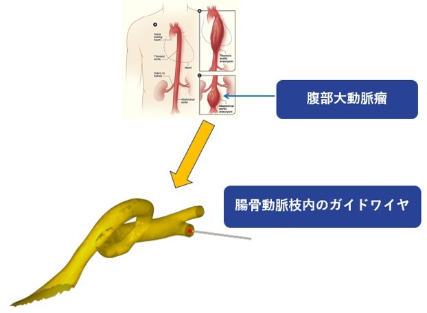 ガイドワイヤが人体組織に与える影響