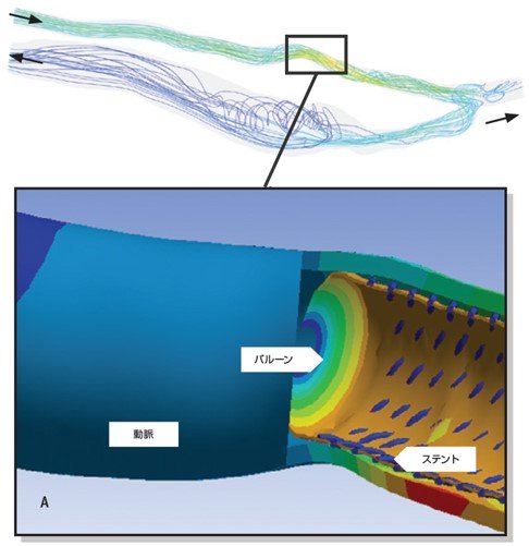 ステント留置後の血流解析​